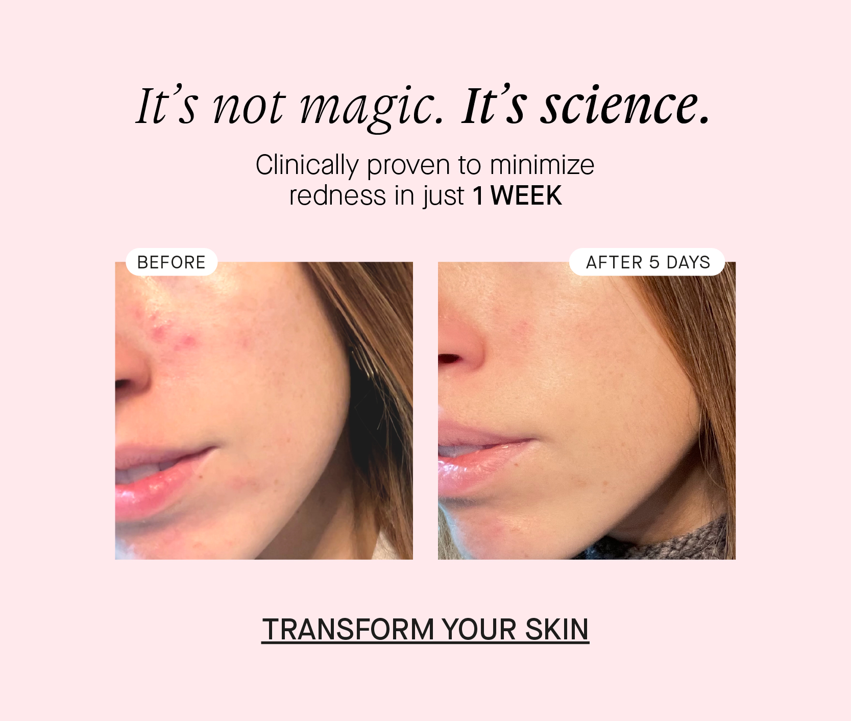 Its not magic. Its science. Clinically proven to minimize redness in just 1WEEK BEFORE AFTER 5 DAYS TRANSFORM YOUR SKIN 
